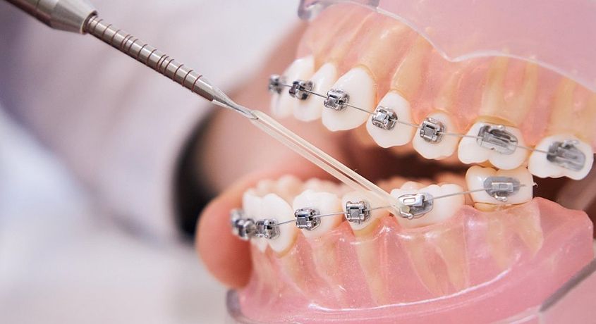 Первый шаг к вашей уверенной улыбке! Скидка 50% на установку металлических или керамических брекетов в стоматологии «Улыбка».